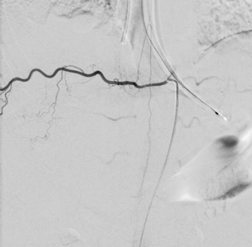 spinal_angiography_san_diego_ccns
