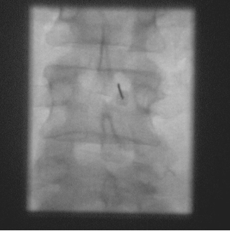 Translaminar_Epidural_Injection